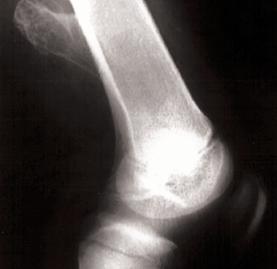 Figure 2. Lateral view radiograph of the knee joint showing an osteochondroma extending in a retrograde direction from the distal femoral region. function.