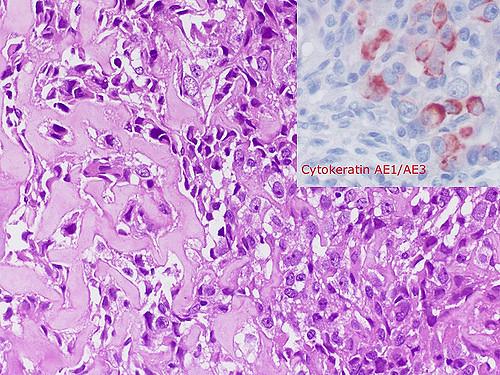 Cytokeratin and EMA usually negative in osteosarcoma but positive cases
