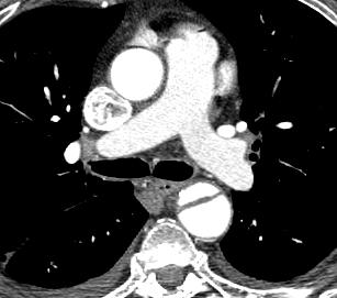 Aortic Dissection Approach to CT Interpretation Type Distal