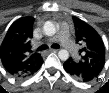 in SVC Motion artifact - aortic sinuses Anatomic pitfall