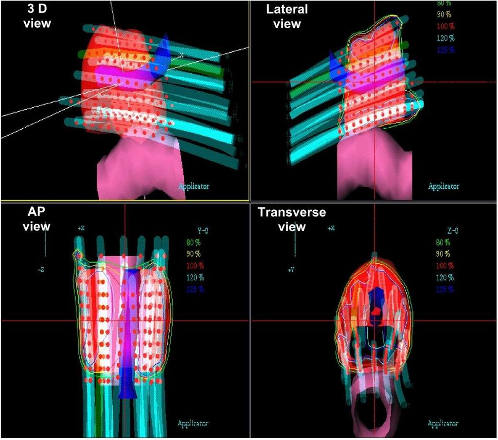 13.6 DOSE CALCULATION PROCEDURES 13.6.2 Computerized treatment planning Prostate treatment with HDR brachytherapy boost to external beam therapy (cont). Four different projections are shown.