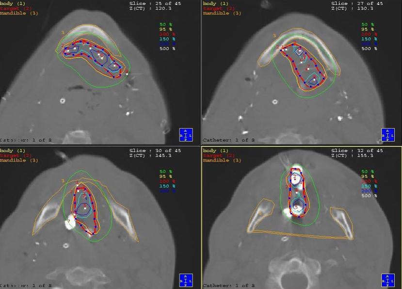 13.6 DOSE CALCULATION PROCEDURES 13.6.2 Computerized treatment planning Tumour of the tongue treated with HDR brachytherapy. Four transverse CT slices are shown.