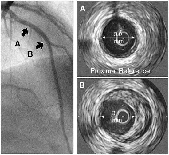 Advantages Vascular Ultrasound Coronary and carotid ultrasound permit direct visualisation of vascular disease