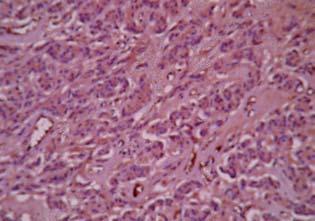 Fig. 4. Non-functioning carcinoma of the parathyroid gland: strongly positive immunohistochemical reaction (PGP-9,5; 200). with finely dispersed chromatin and nucleoli.