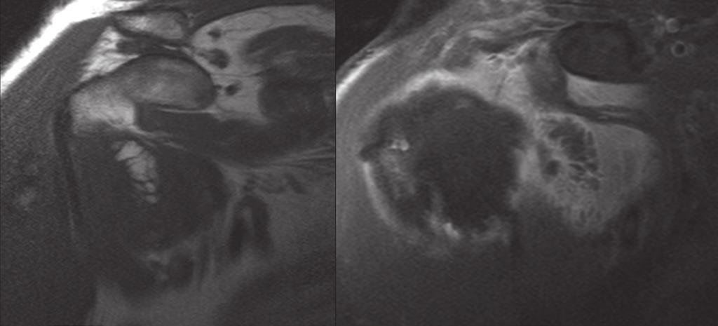 Fat suppressed oblique mid-coronal (left) and oblique sagittal