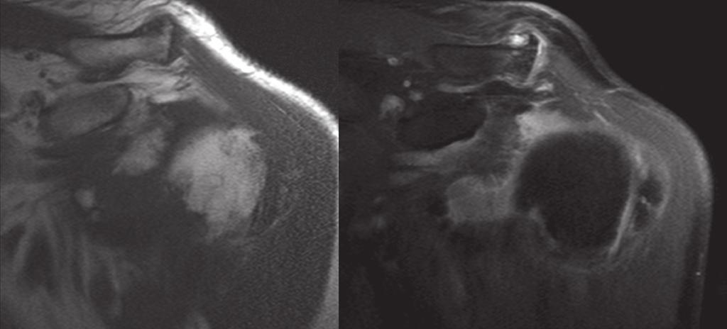 MR imaging, left shoulder.  (right) STIR 3 Fig. 4.