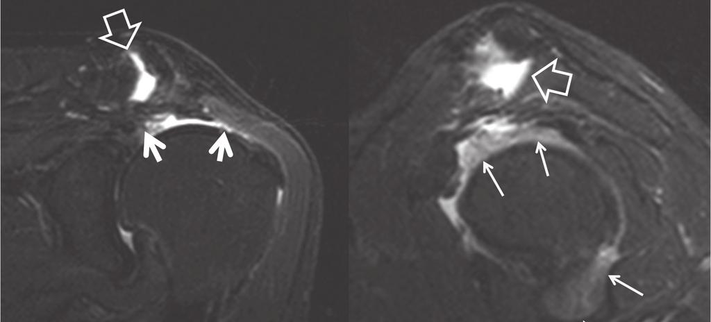 Bilateral Shoulder Pain, p. 64-69 HR J Fig. 1. MR imaging, right shoulder. Fat suppressed oblique mid-coronal (left) and oblique sagittal (right) STIR.