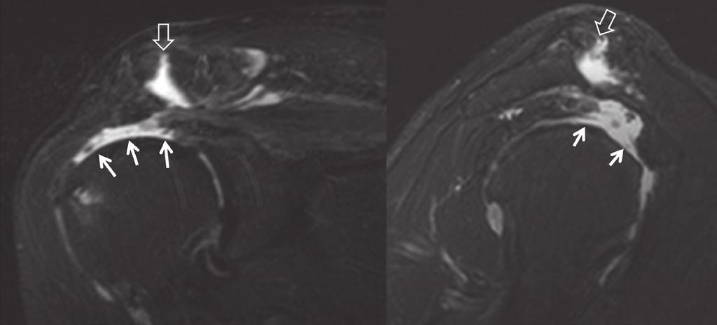 enhanced T1W (right) MR images. A fatty villonodular intra-articular lesion (arrows) and synovitis (open arrows) are shown 2 Fig. 3. MR imaging, left shoulder.