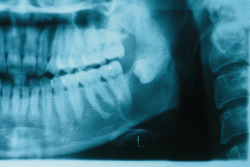 Lasers in Dentistry: - Anatomy of the Mouth We, obviously, haven t gotten to x-rays yet, but here is an x-ray image of at least one abnormality in the mouth. What is the abnormality?