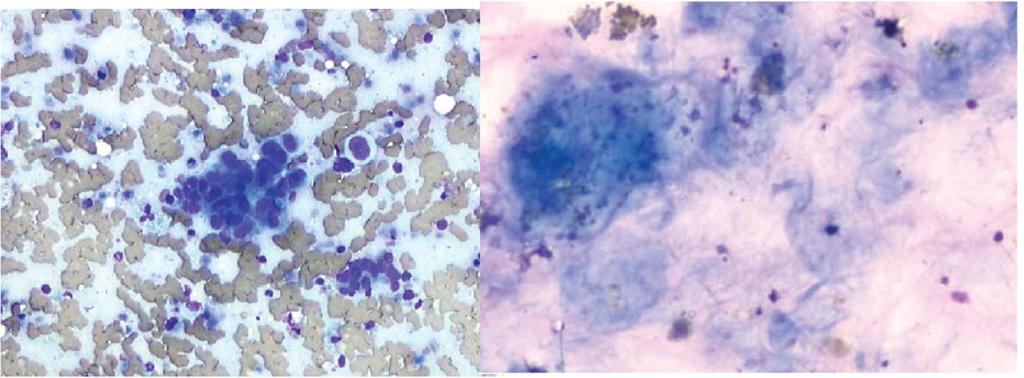 Typical examples of a clearly malignant (A) and a nondiagnostic (B) finding illustrating the limitations of cytologic analyses.