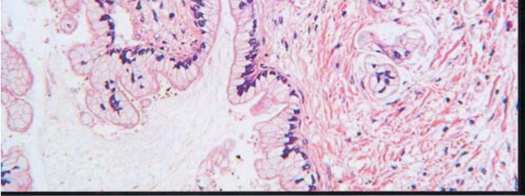 b Biopsy specimens obtained by EUS-FNAB revealed well-differentiated adenocarcinoma in this