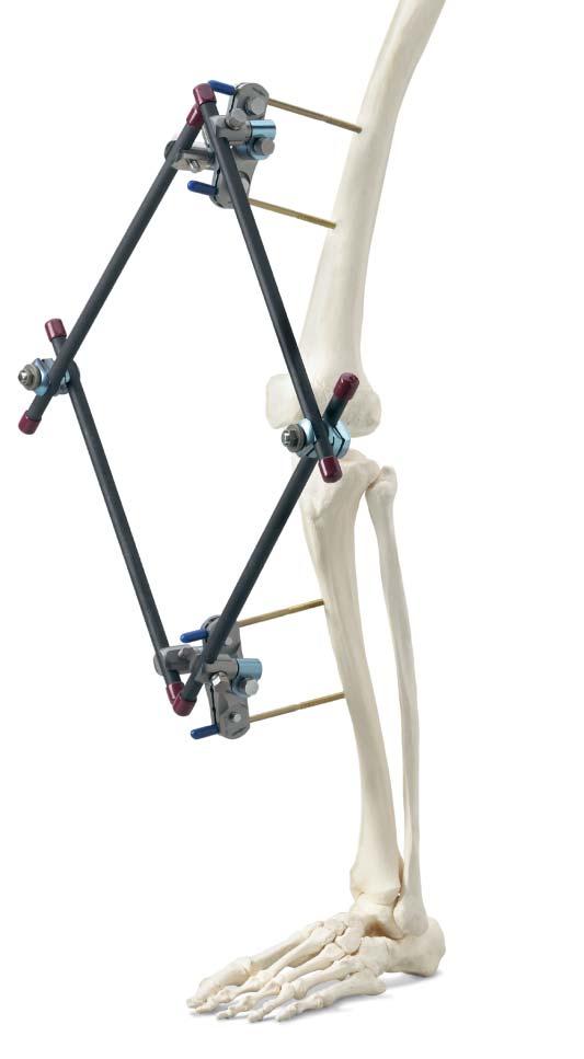 Optional Frame Configuration Enhancing the frame for additional stability Construct medial frame Connect multi-pin clamps with two carbon fiber rods and a combination clamp on the medial side.