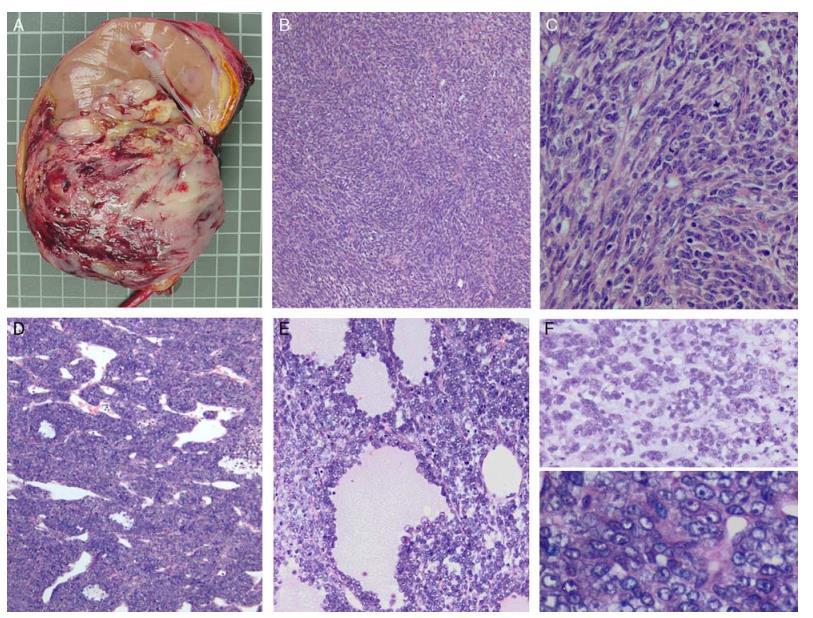 CIC-DUX4 sarcoma of the kidney 1 9-year-old boy right kidney tumor Radical nephrectomy