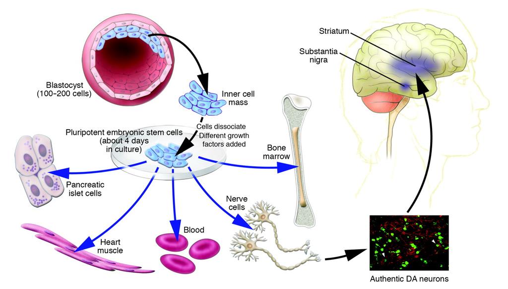 Pluripotent Stem cells and their potential in PD Stem cells promising Not ready for PD Only