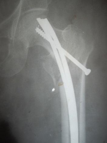 months. Our study included 50 patients having intertrochanteric fracture. Inclusion criteria: all patients having intertrochanteric fracture of femur with intact lateral wall of greater trochanter.