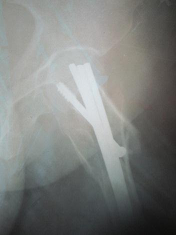 Amongst various classification systems we have used Boyd and Griffin classification for intertrochanteric fractures.