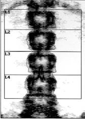 DXA Measurements of Spine & Hip Lumbar spine Proximal femur