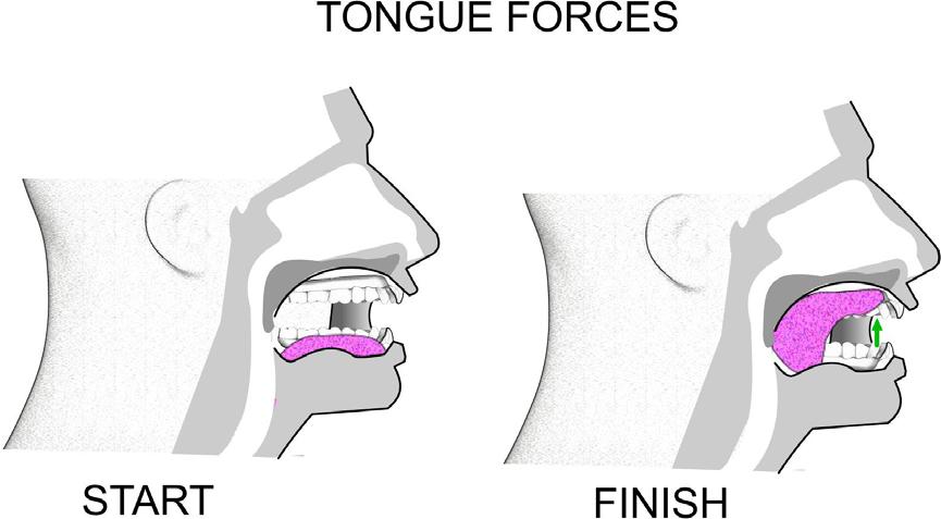 TONGUE FORCES 1. Forcibly suck your tongue upward until the whole tongue is against your palate. 2. Hold this position for 4 seconds. 3. Repeat 5 times. 1. Force the back of your tongue downward until the whole tongue is resting on the floor of your mouth.