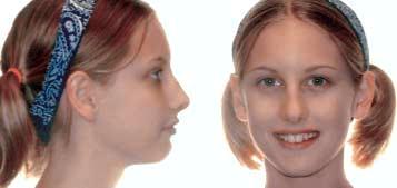 Figure 8: The patient exhibited a convex facial profile with good lip balance. Figure 9: Start cephalometric tracing.