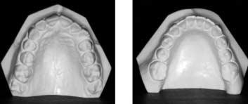 After three appointments, the overjet and overbite had been corrected. The bite opening bends were removed from both archwires and replaced with mild bite opening sweeps.