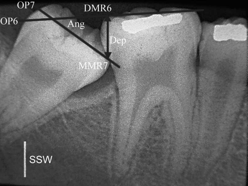 IMPACTED MANDIBULAR SECOND MOLARS 671 Figure 3. Force delivered to the pole arm and force as well as moment acting on the impacted molar.
