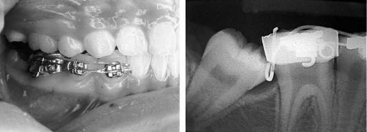 2,4,5,7 Problems associated with impacted second molars are caries, periodontitis, resorption of adjacent teeth, cyst formation, malocclusion, and pain.
