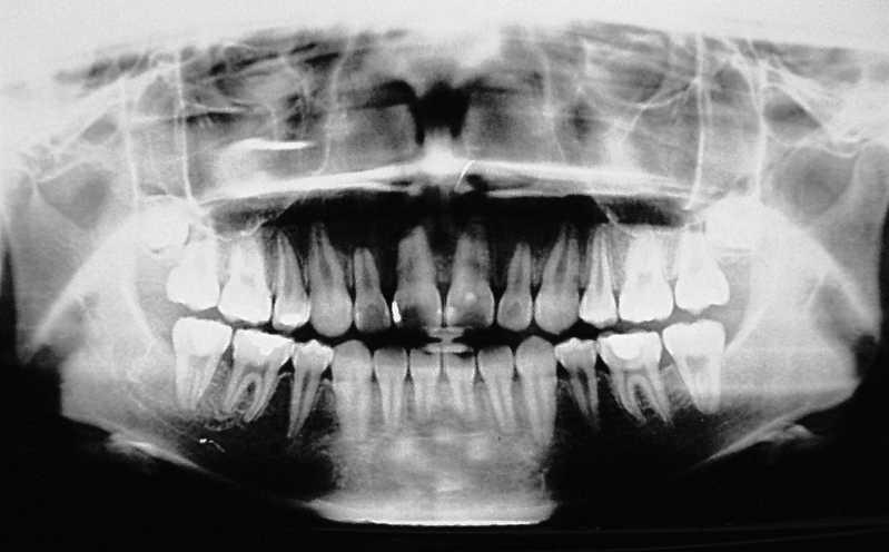 674 FU, WANG, WU, HUANG, CHEN, TSENG, TSENG, HUNG Figure 6. Posttreatment panoramic radiograph showing corrected inclination of mandibular second molars. impacted MdM2.
