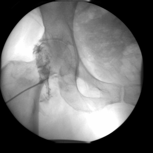 Our Patient: Hip Arthrogram Non uniform distribution of contrast within joint