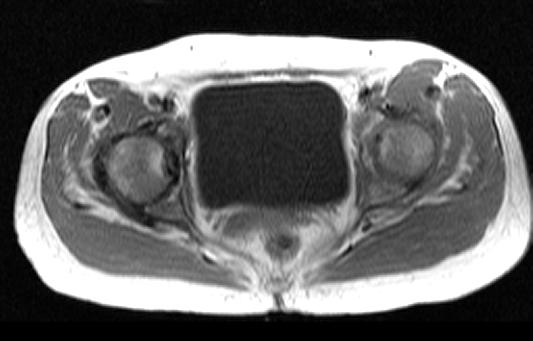 Our Patient: MRI Proximal areas of