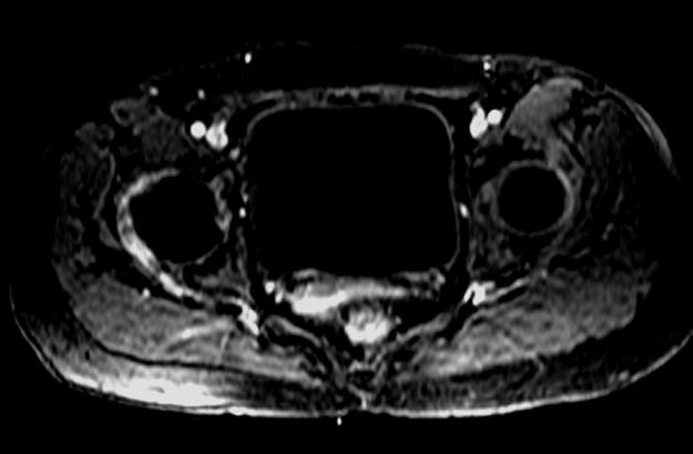 Our Patient: MRI with contrast Region