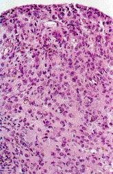 PVNS - Histology Fibrous stroma Hemosiderin deposition Histiocytic infiltrate Giant cells From
