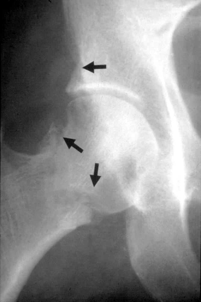 PVNS Radiographic Features Soft tissue swelling 80% Bony destruction Joint space narrowing Later in disease 70-75% of hip cases