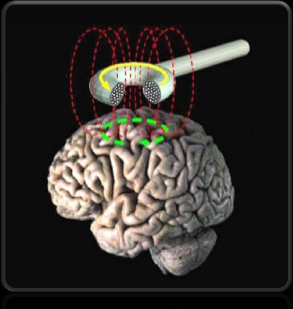 Transcranial Magnetic Stimulation TMS