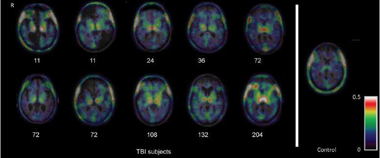 Chronic microglial activation after TBI Ramlackhansingh et al.