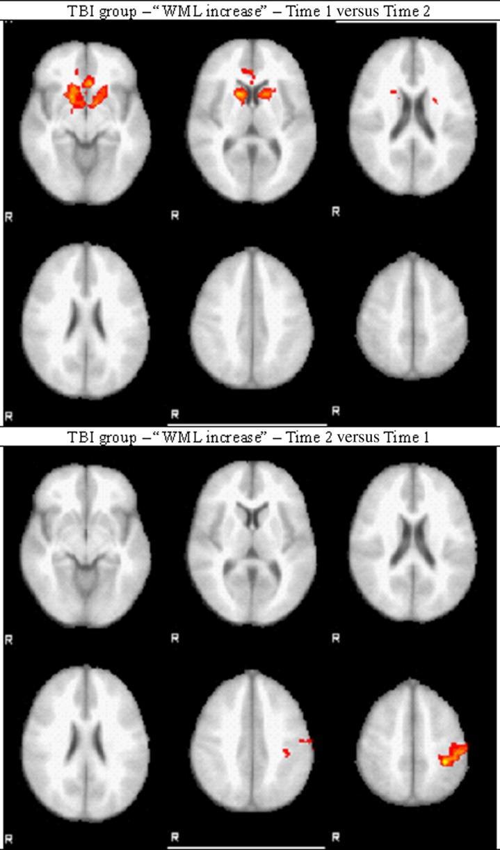 Chronic neurodegeneration after TBI Cazalis