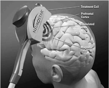 through electrical stimulation of the area of the brain believed to be responsible for mood (Neuronetics, Inc., 2010 ) Barker & Jalinous, 1985 3 38 How Does TMS work?