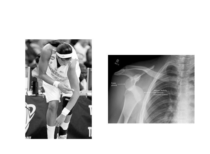 Posterior Glenohumeral Instability Less Common Adduction/Forward Flexion/Internal Rotation Offensive