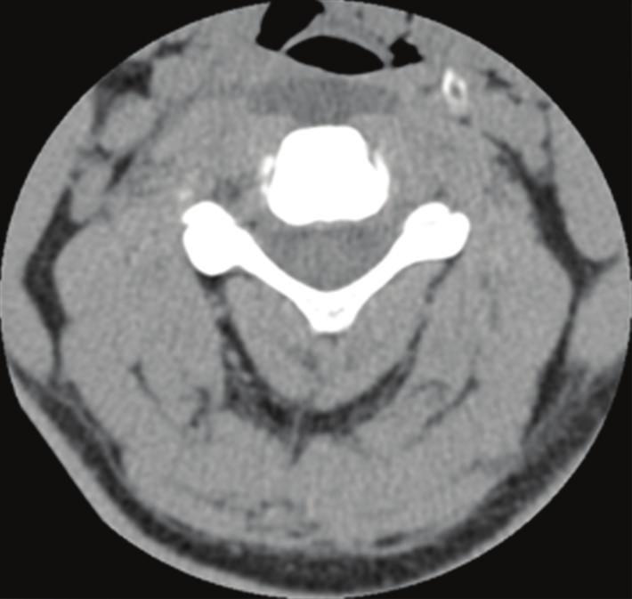 2 Case Reports in Otolaryngology Figure 1: Axial noncontrast CT scan of the cervical spine