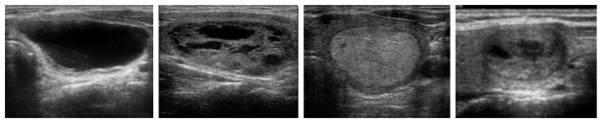 Echographic Classification Of thyroid Nodules According to the Risk of Malignancy (ECON- ARM)