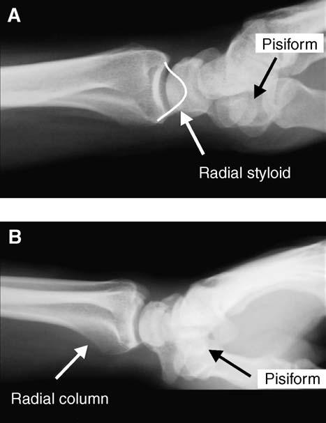 DISTAL RADIUS FRACTURES: RADIOGRAPHIC EVALUATION 281 pisiform should overlap the distal pole of the scaphoid.