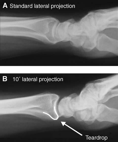 is positioned in relative supination (Fig. 3A,B). In a standard lateral projection, the radiograph beam is oriented perpendicular to the long axis of the radial shaft.