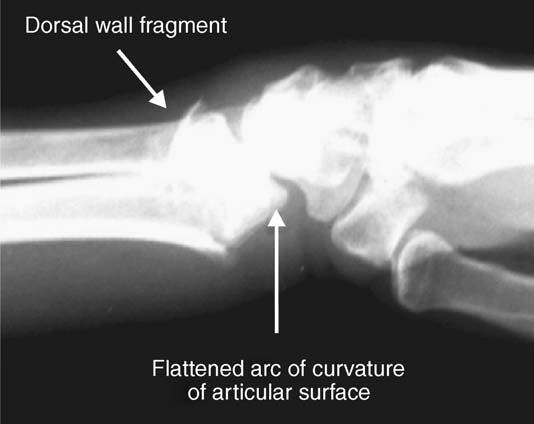 282 MEDOFF restored. Careful assessment of the teardrop should be a standard part of radiographic evaluation for distal radius fractures. Radiographic parameters Posteroanterior view Fig. 5.