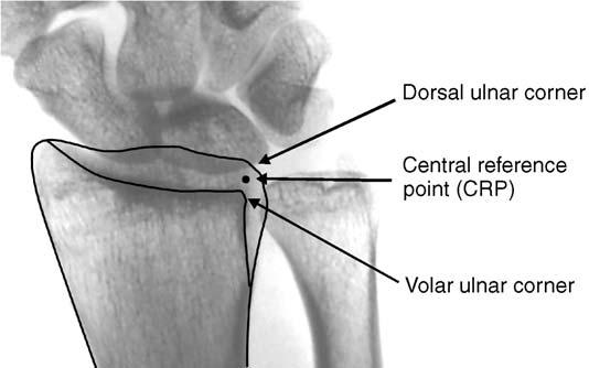 In addition, dorsal rotation of the teardrop, often seen in conjunction with axial loading injuries, can produce significant articular incongruity that can be overlooked easily even if radial