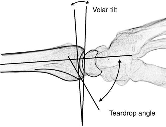 DISTAL RADIUS FRACTURES: RADIOGRAPHIC EVALUATION 283 Fig. 8. Measurement of radial inclination and ulnar variance to the CRP.