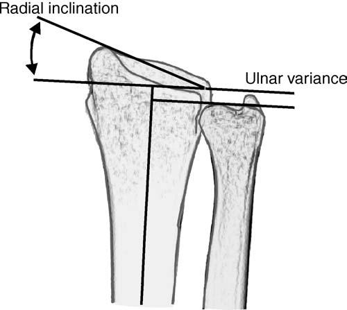 Intra-articular fractures with impaction of the proximal carpal row into a fracture defect reduce this value; a radiocarpal interval in excess of 3 mm implies overdistraction of the joint, usually in