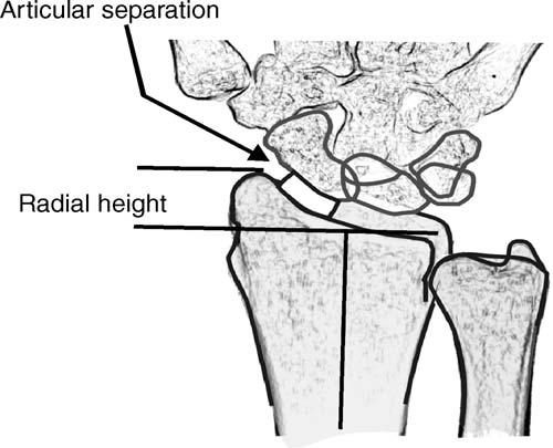 Lateral view Volar tilt is measured on the lateral view as the angle formed between a perpendicular to the longitudinal axis of the radial shaft and a line formed by connecting the apex of the volar