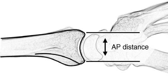 Distal radius fractures, particularly axial loading injuries, can cause the volar and dorsal rim fragments to explode away from each other as the lunate is driven into the articular surface.
