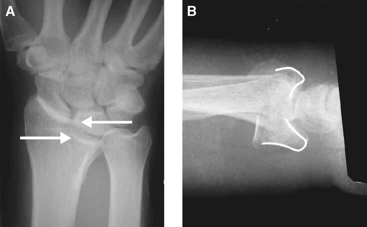 286 MEDOFF Fig. 13. Articular step-off and articular separation with intra-articular fractures. (A) Articular step-off seen as discontinuity of the carpal facet horizon.
