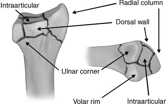 The dorsal wall fragment is recognized easily by close inspection of the lateral radiograph.