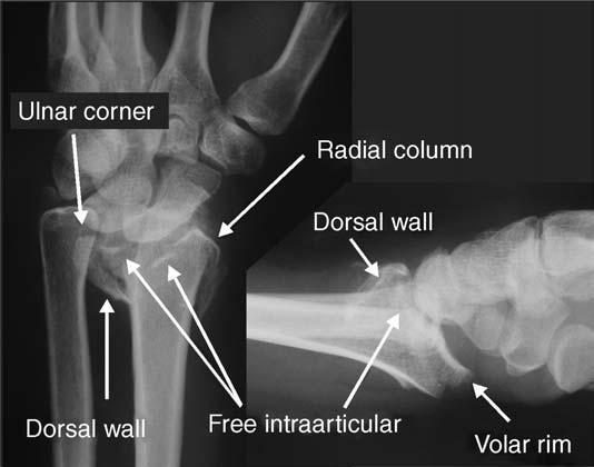 Occasionally the dorsal wall fragment may rotate 90( in an orientation parallel to the radiographic beam and may appear as a radiodense line crossing transversely at the proximal extent of the